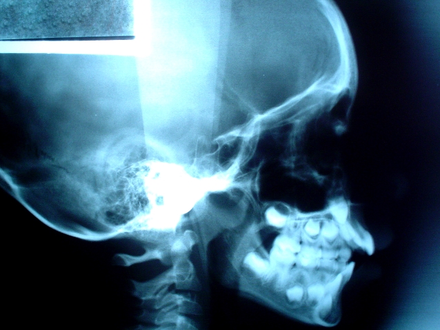 boczny rentgen czaszki 