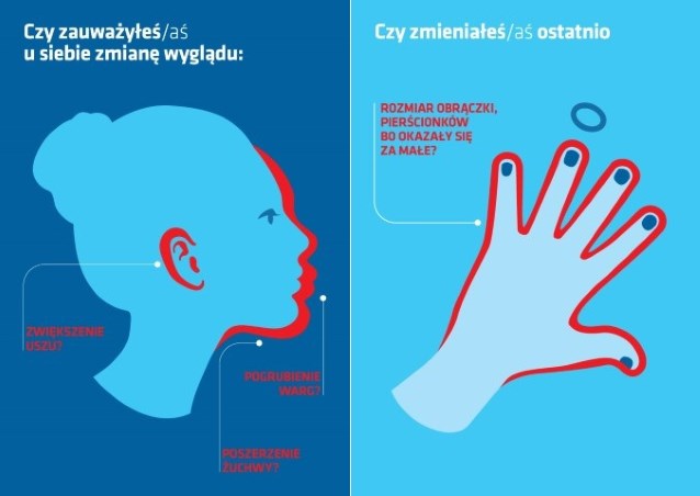 akromegalia objawy, tekst alternatywny poniżej