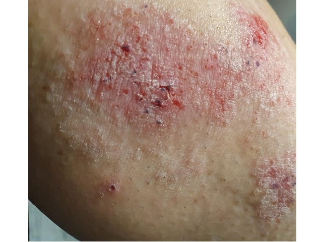 skóra z chorobą AZS czerwone rozdrapane rany