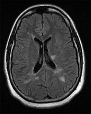zdjęcie: Liczne plaki (miejsca, w których doszło do uszkodzenia mózgu w przebiegu stwardnienia rozsianego) widoczne w sekwencji FLAIR MRI, fot. Wikipedia