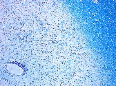 zdjęcie: Demielinizacja w stwardnieniu rozsianym. Barwienie mieliny Klüvera-Barrera, Dostrzegalne odbarwienie w miejscu zmiany (oryginalne powiększenie 1:100), fot. Wikipedia