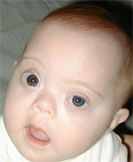 zdjęcie: dziecko z zespołem Downa, fot.: Wikipedia